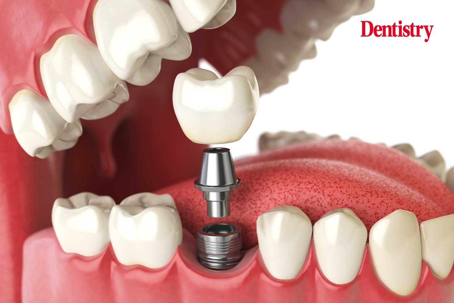 New dental implant technology developed by researchers Dentistry