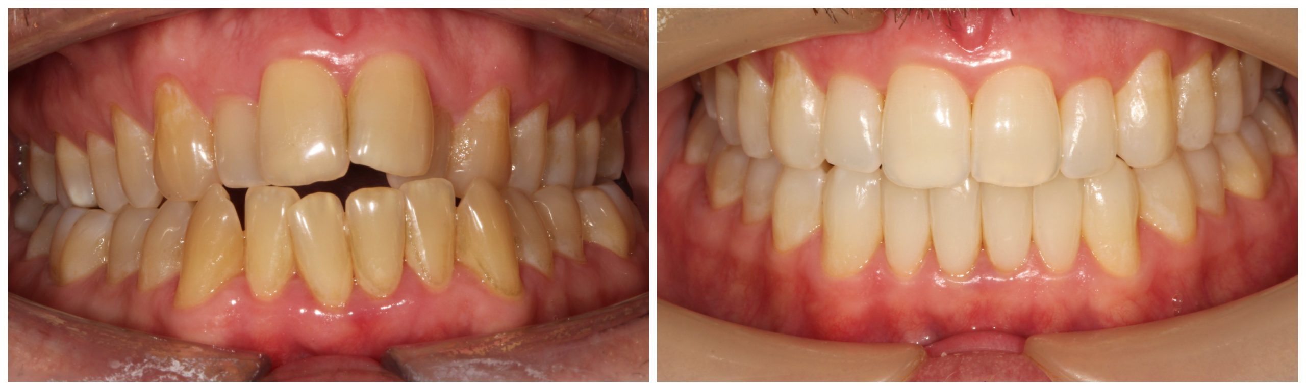 before and after Invisalign treatment