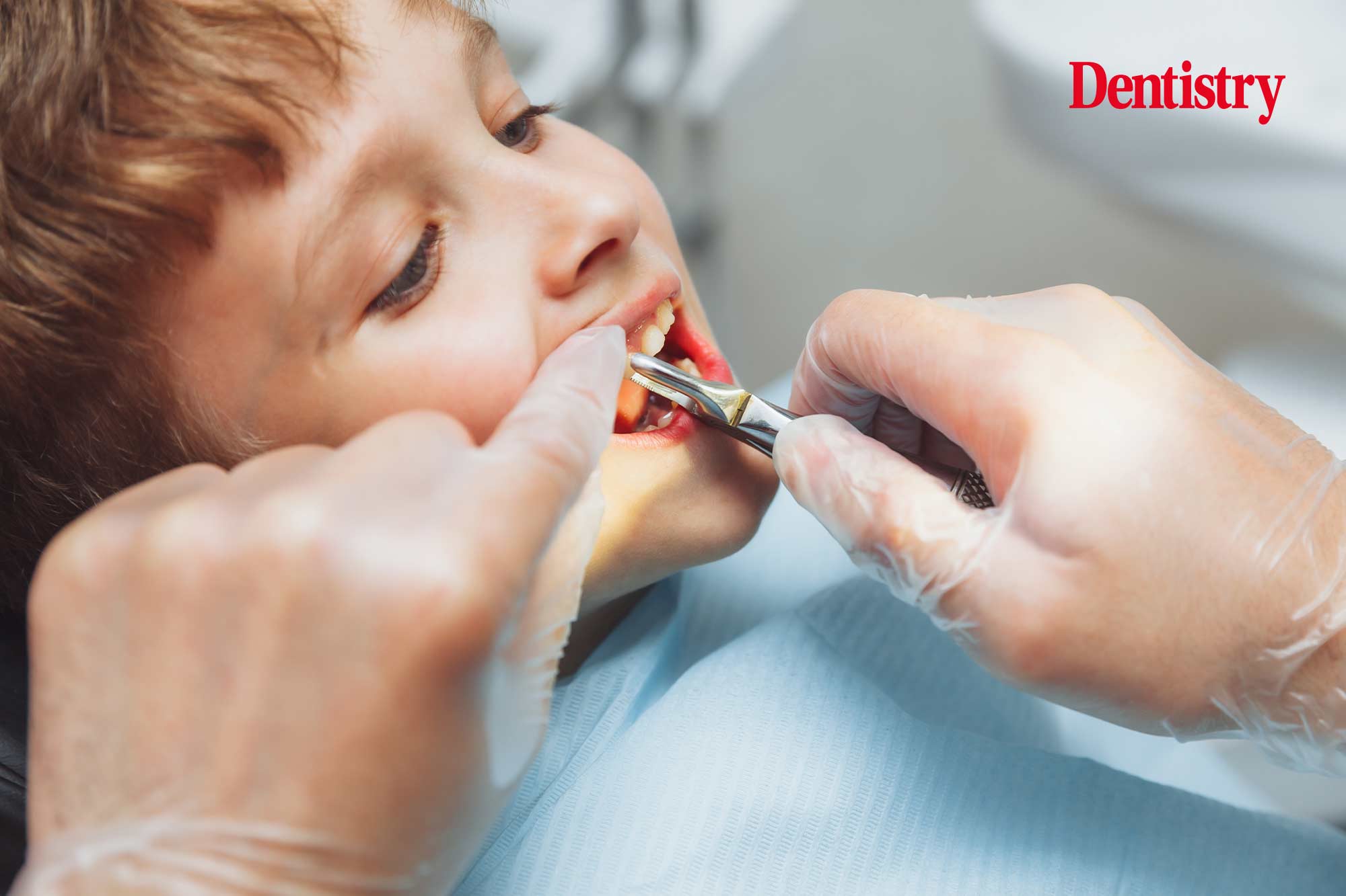 The number of children attending hospital for tooth extractions has risen by 17%, government figures show.