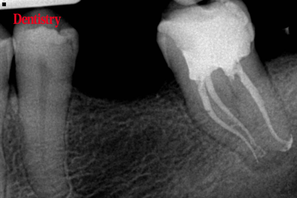 NiTi files - endodontic simplicity