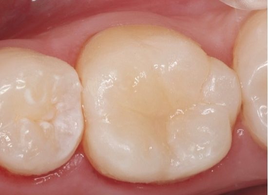 Figure 10: The same restorative and polishing protocol was used to restore the LL6