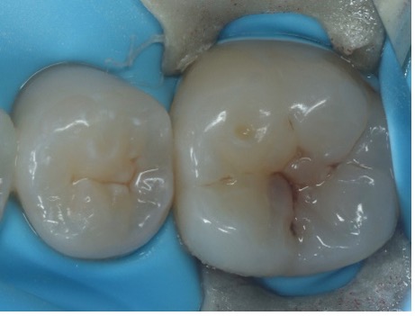 Figure 1 and 2: Occlusal caries was noted on the UL6 and LL6