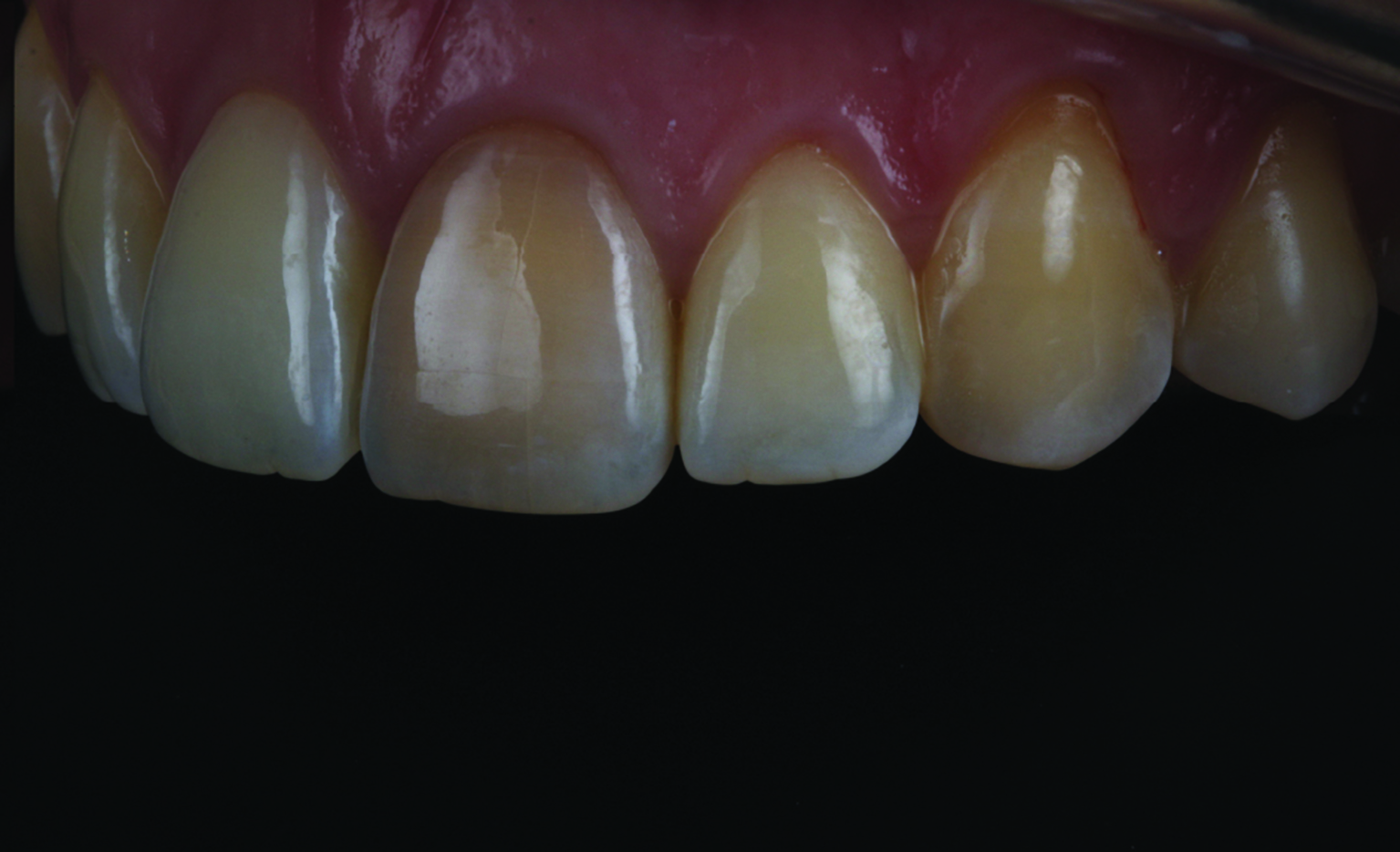 Case study: enhancing smiles with tooth whitening - Dentistry