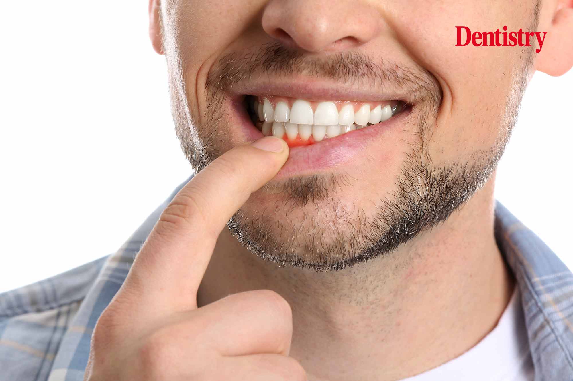 Gum disease 'caused by immunosuppression of skin cells in mouth'
