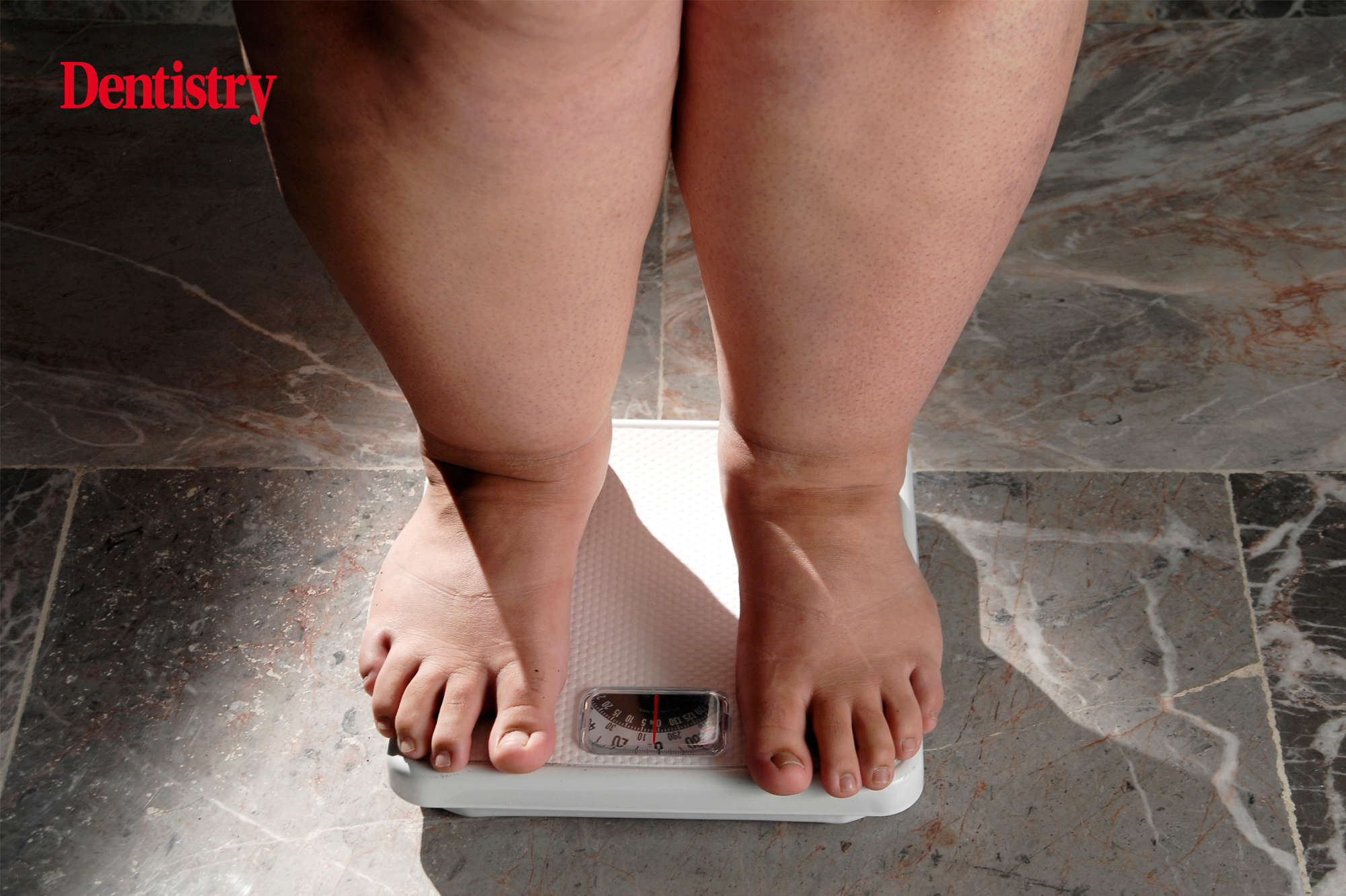 Obesity linked to genetic trigger, study finds