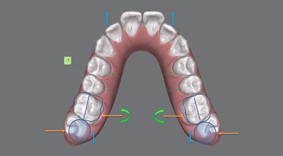 The SAFE approach: facially generated treatment planning in clear aligner therapy