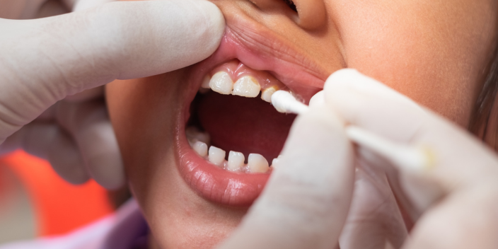 Caries management in children
