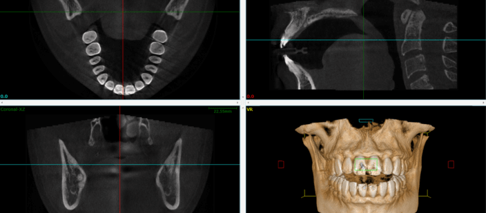 Acteon scanner x-rays