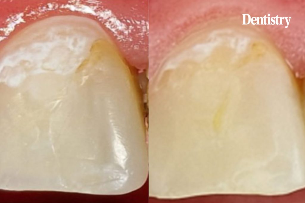 Case study: caries management with guided enamel regeneration