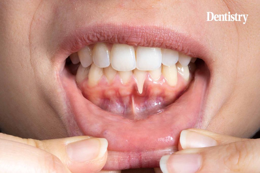 Toothbrush-shaped ultrasound could be used for gum monitoring