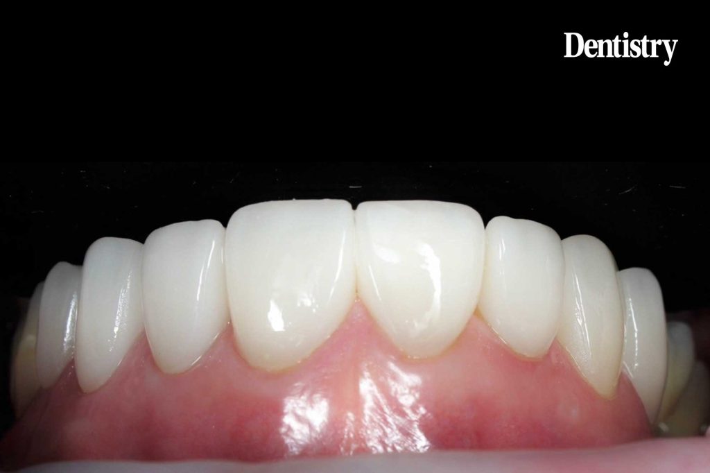 How Dr Hassan is elevating patient outcomes with First Fit veneers