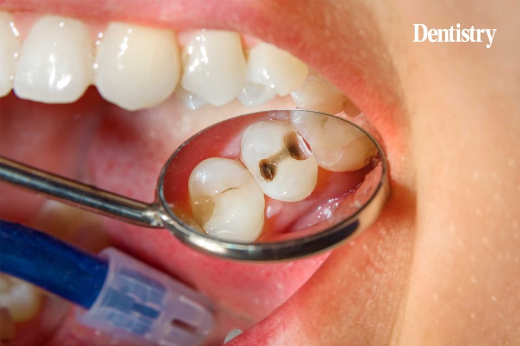 Bio-Bulk fill treatment of deep caries: clinical case