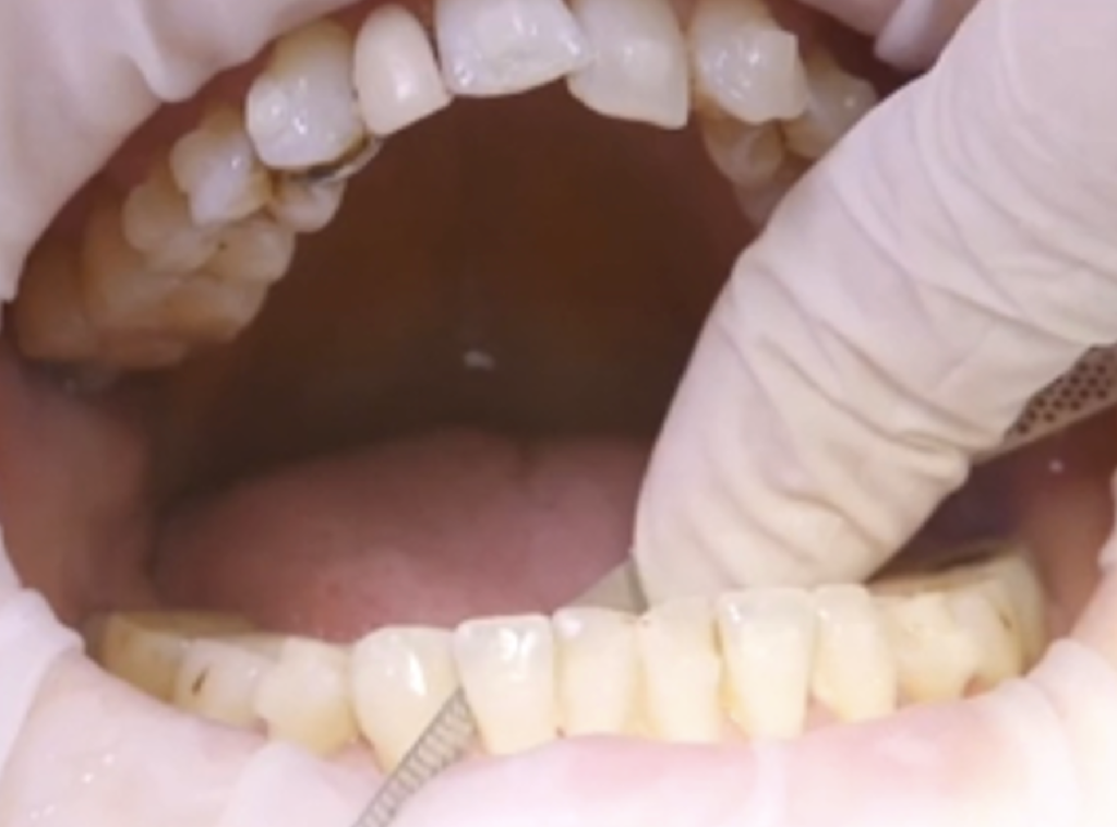 Mastering interproximal reduction (IPR): elevating clear aligner outcomes