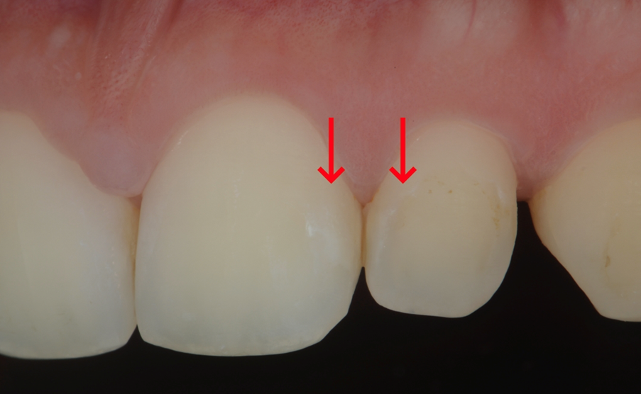 Biologically driven, non-invasive caries management: case studies