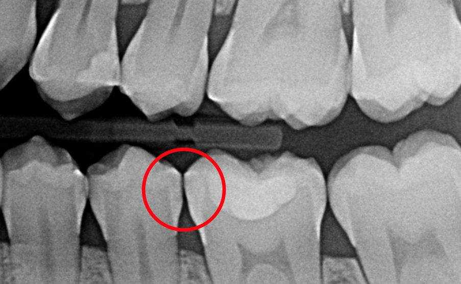 Biologically driven, non-invasive caries management: case studies
