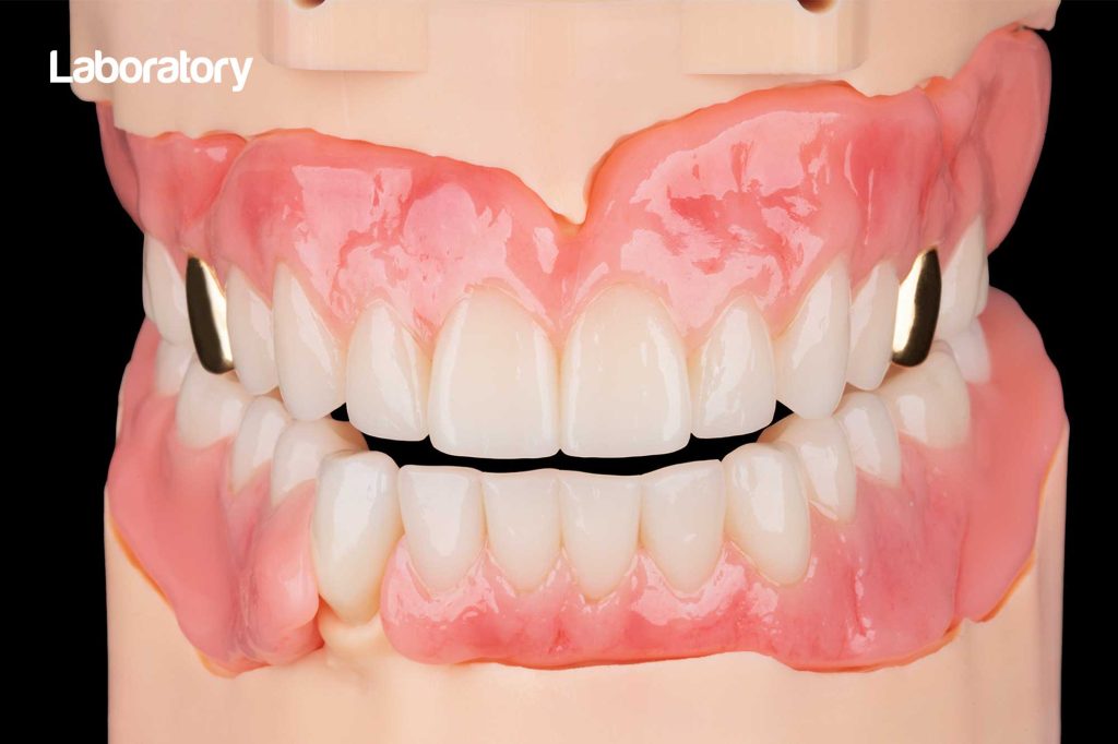 Lecture on the digital workflow for full dentures