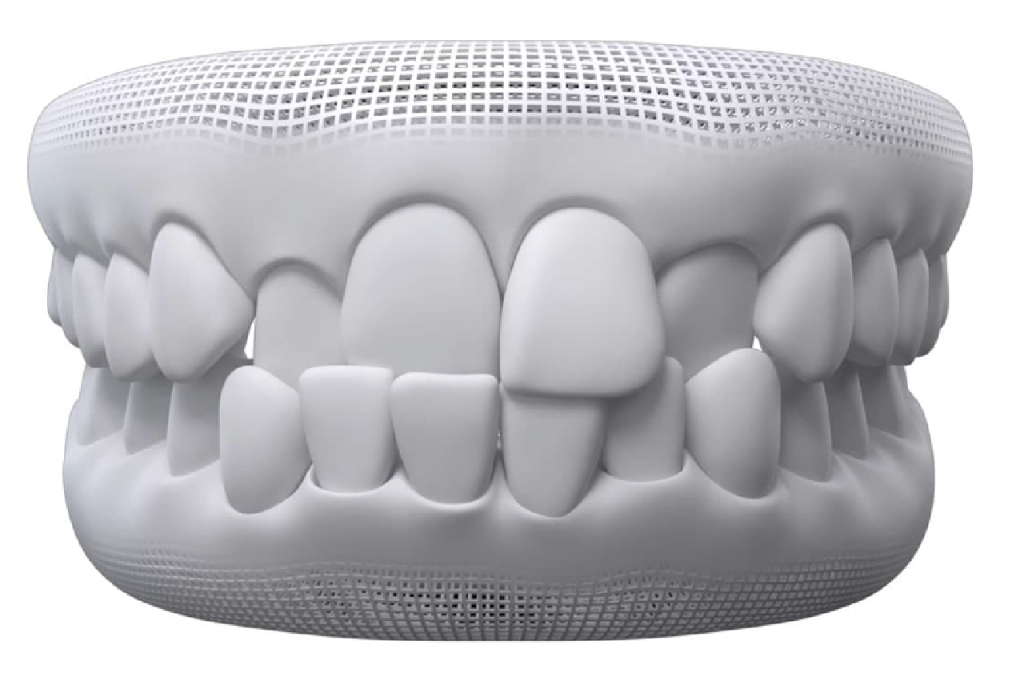 Mastering crossbite cases with Invisalign