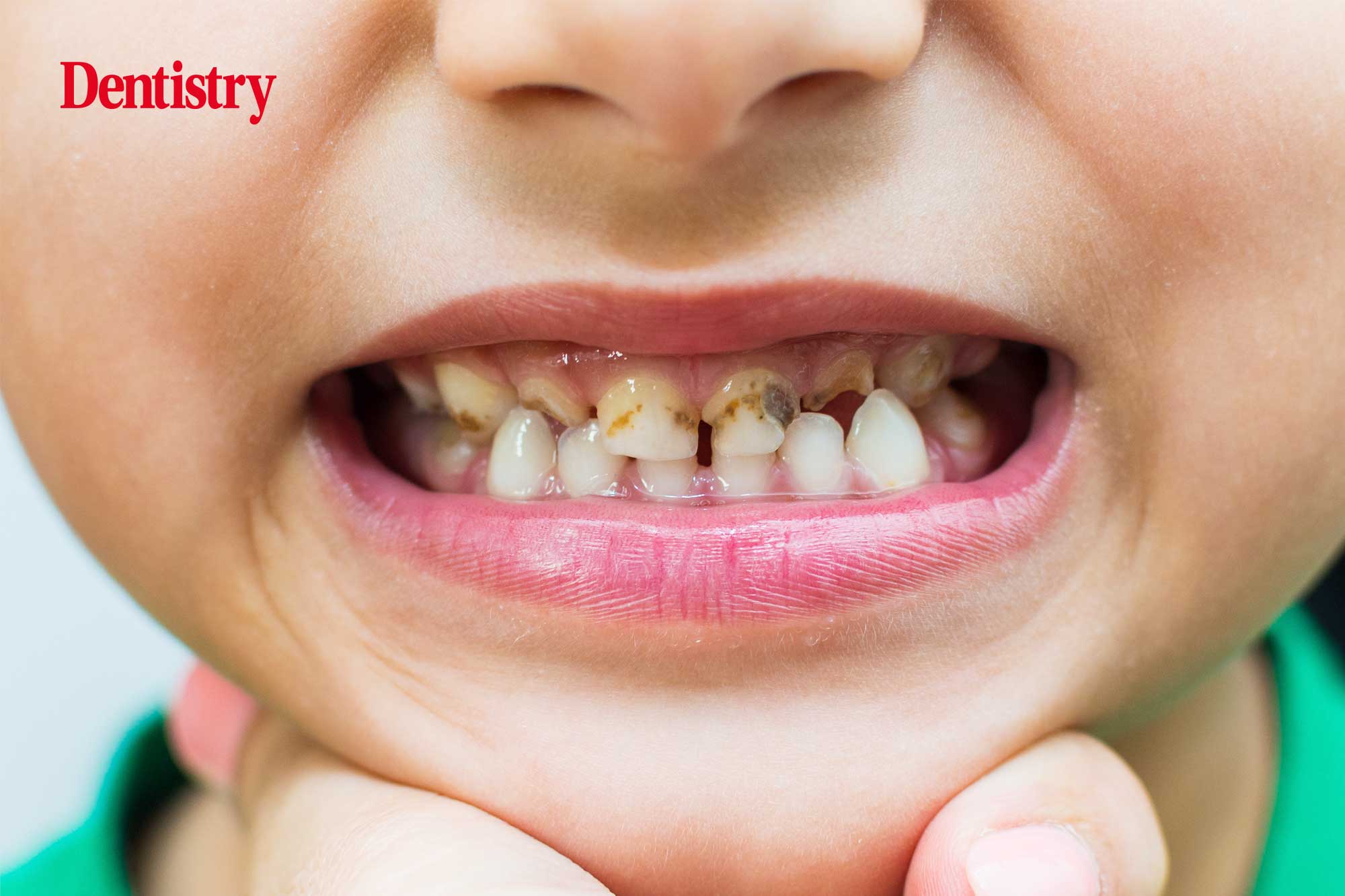 How many patients present with active caries?