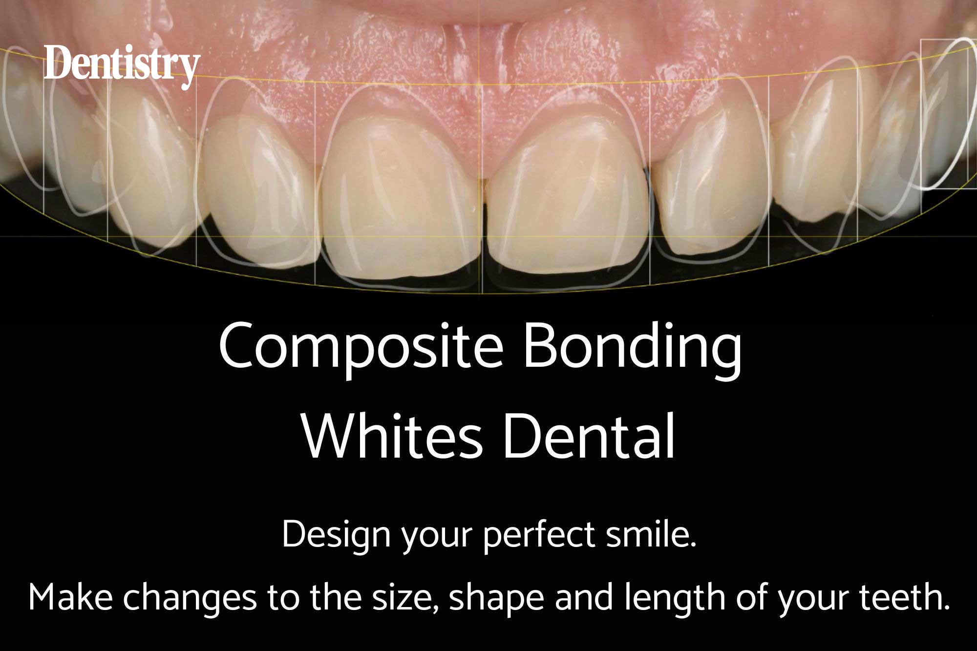 How composite bonding is changing smiles across London