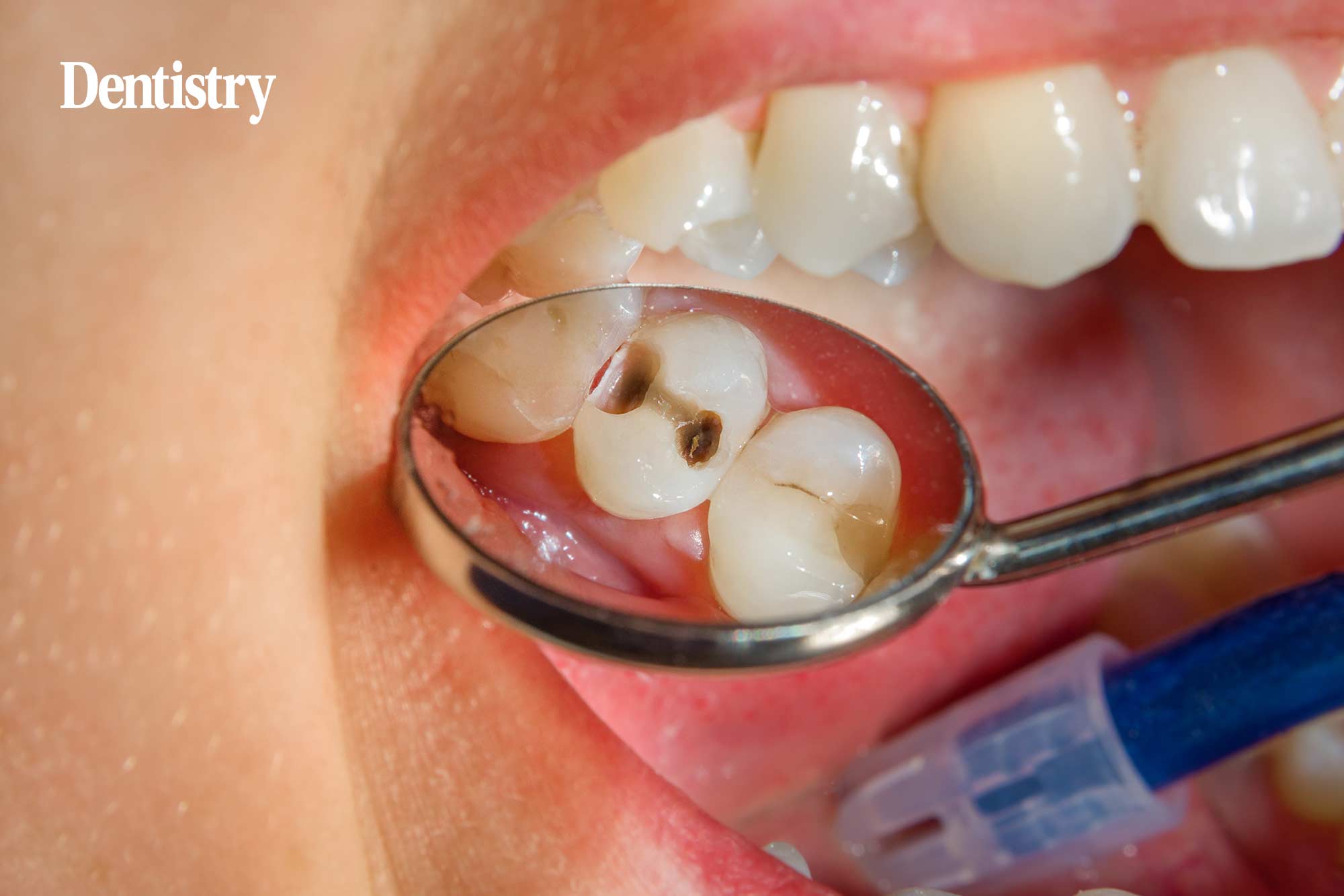 Oral health in Scotland reveals 'stark and persistent inequalities'