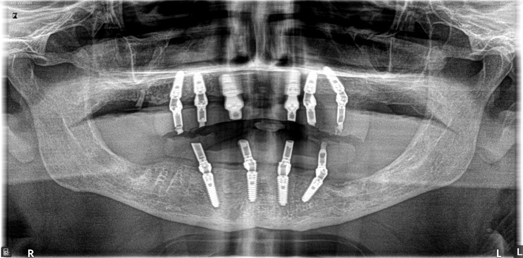Highlighting patient care in a complex implant case