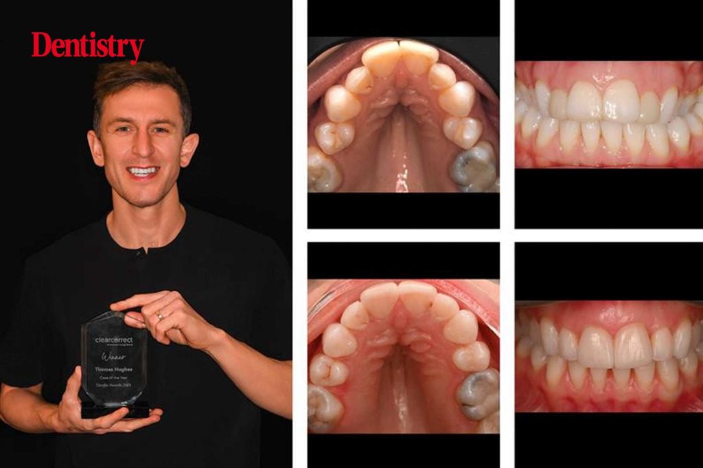 From complexity to confidence: the case for clear aligners