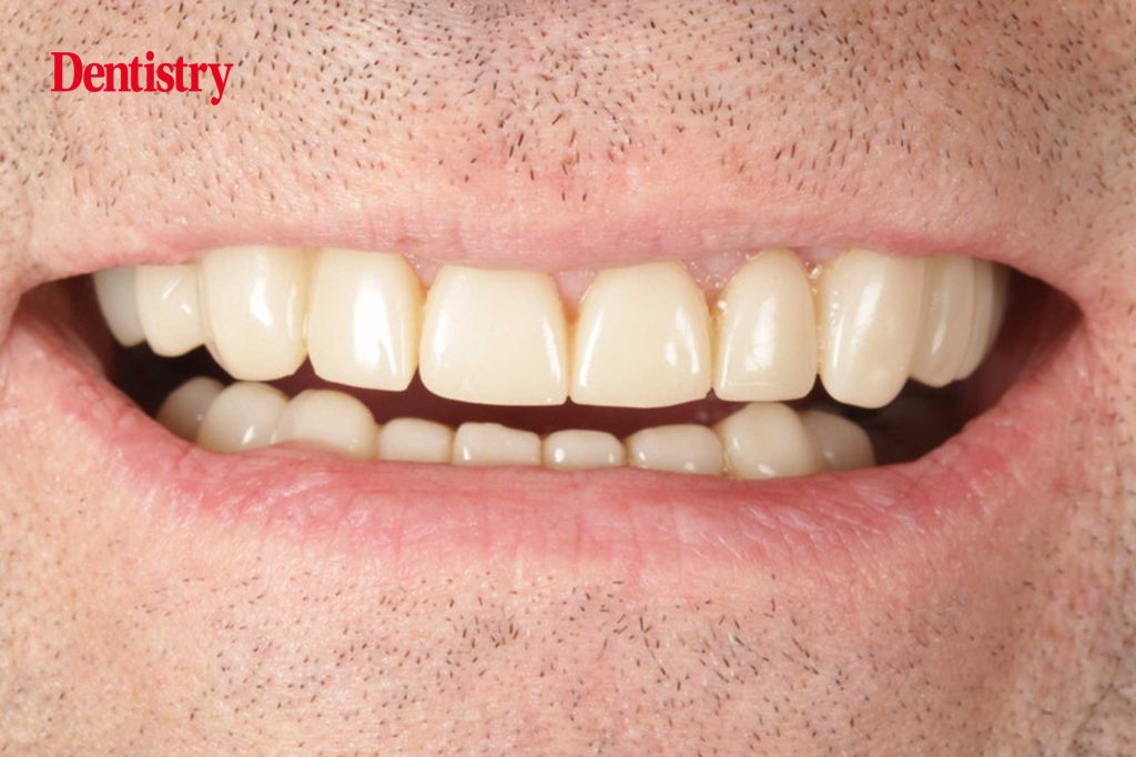 Full-mouth rehabilitation of a severe tooth wear case using SprintRay 3D-printed crown resin