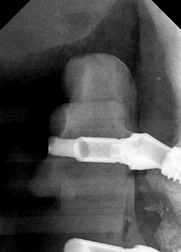 Highlighting patient care in a complex implant case