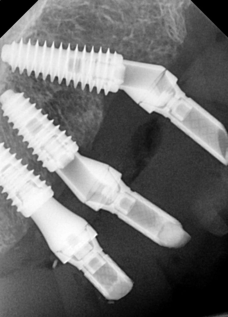 Highlighting patient care in a complex implant case