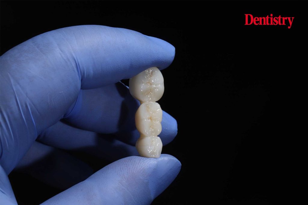 Technology for same-day 3D-printed zirconia restorations developed