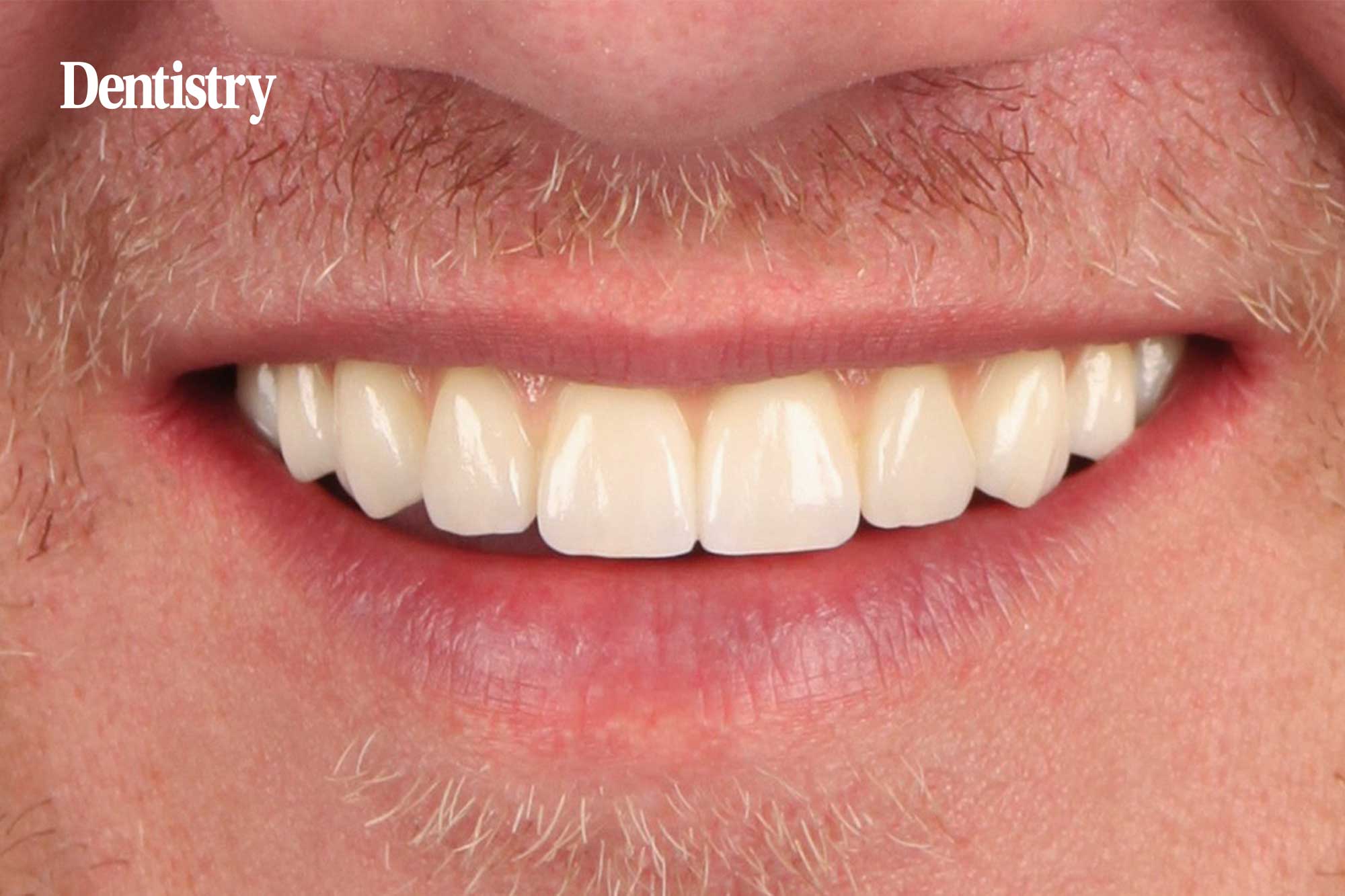 Case report: prosthesis restoration for aesthetics and strength