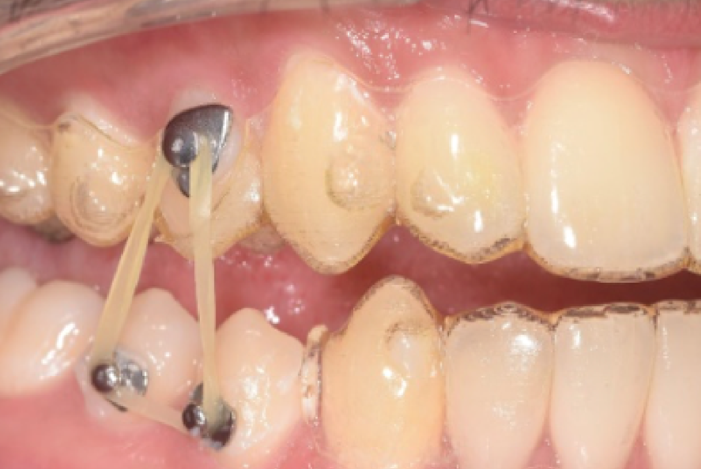 Aligner Dental Academy 2025: master Invisalign with a year of insights