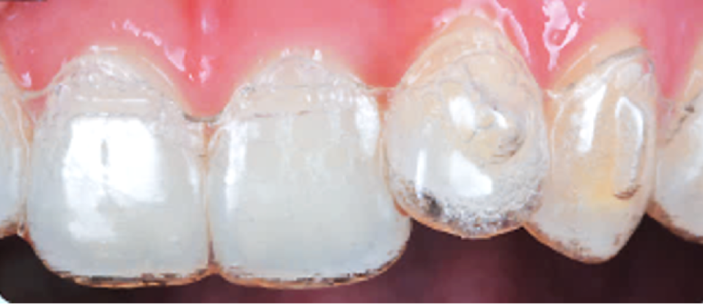 Aligner Dental Academy 2025: master Invisalign with a year of insights