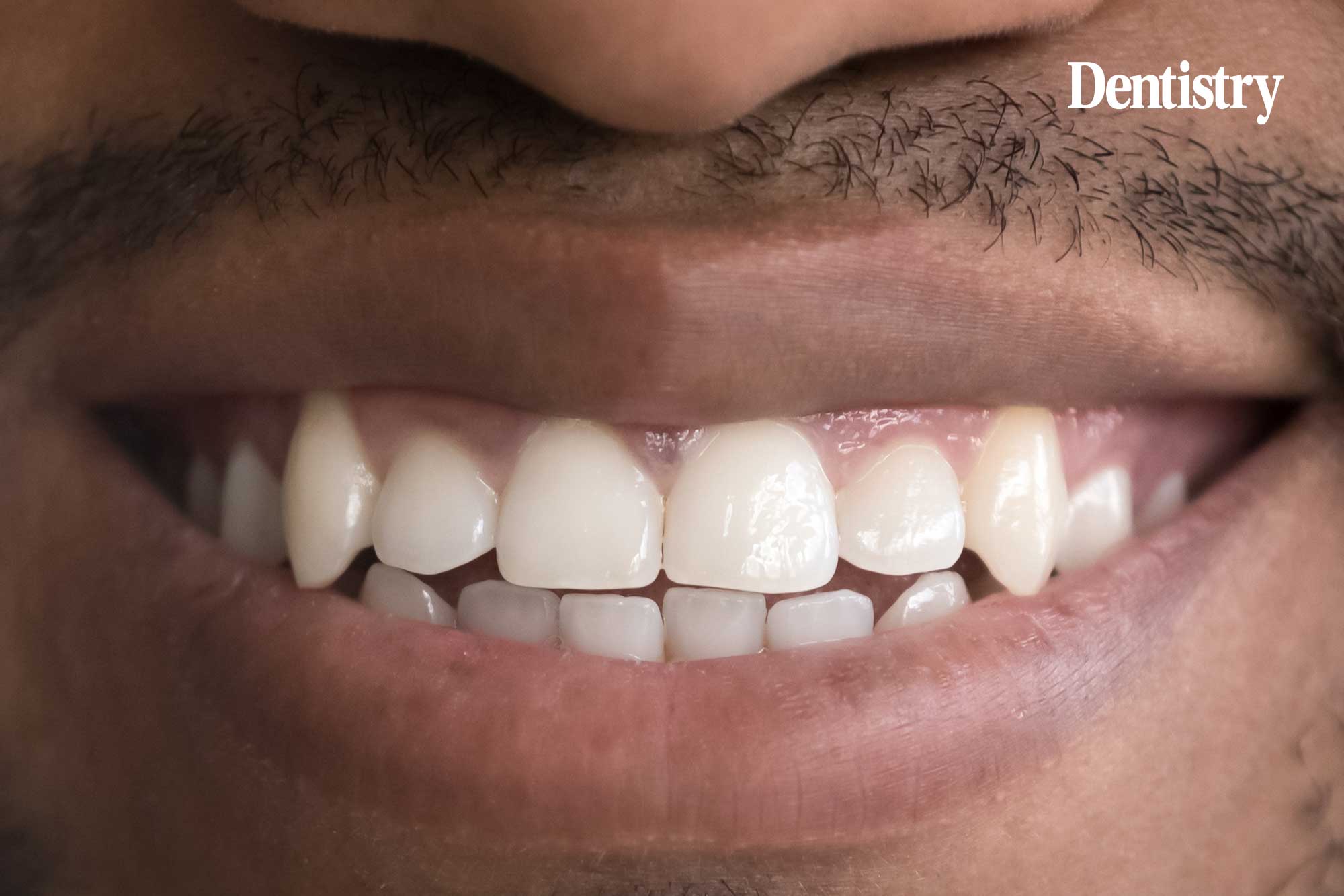 New gel that can regenerate enamel signals 'new opportunities' for dentistry