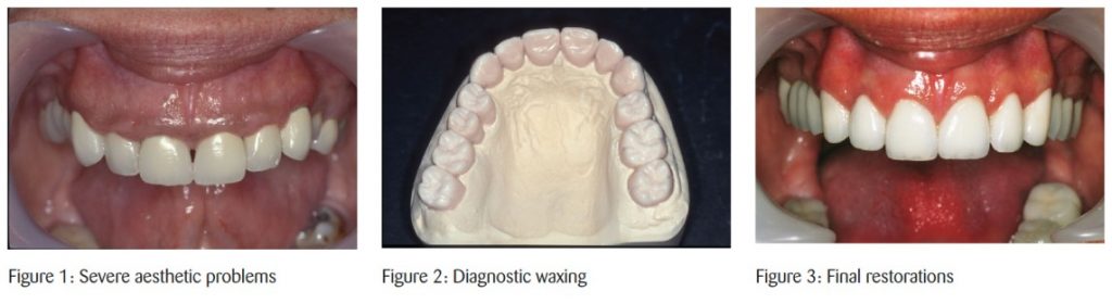 Full-mouth reconstruction in modern practice: timeless principles from one of the UK’s top clinicians