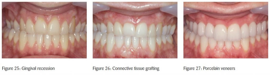 Full-mouth reconstruction in modern practice: timeless principles from one of the UK’s top clinicians