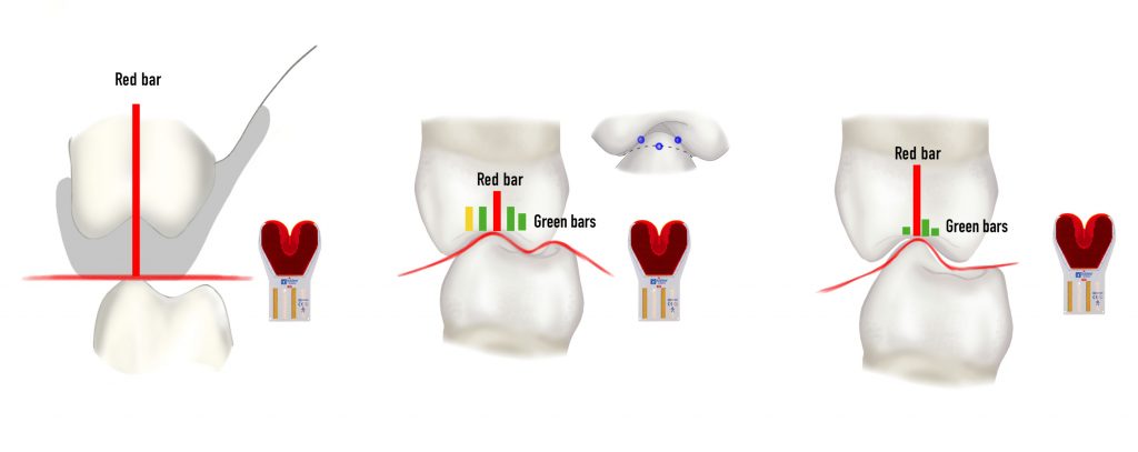 Digital occlusion analysis in adhesive rehabilitation of tooth wear patients