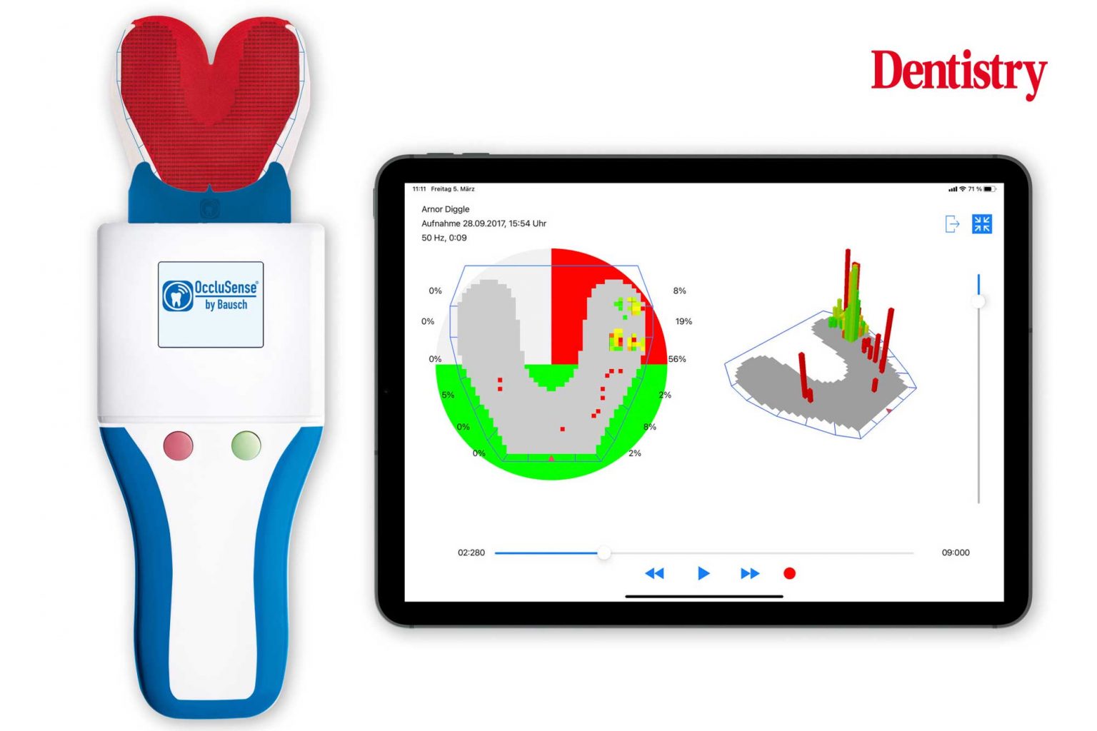 Digital occlusion analysis for tooth wear patients - Dentistry