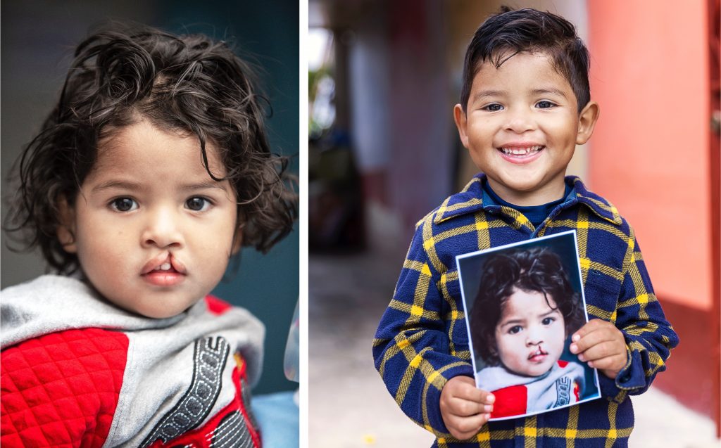 Operation Smile UK