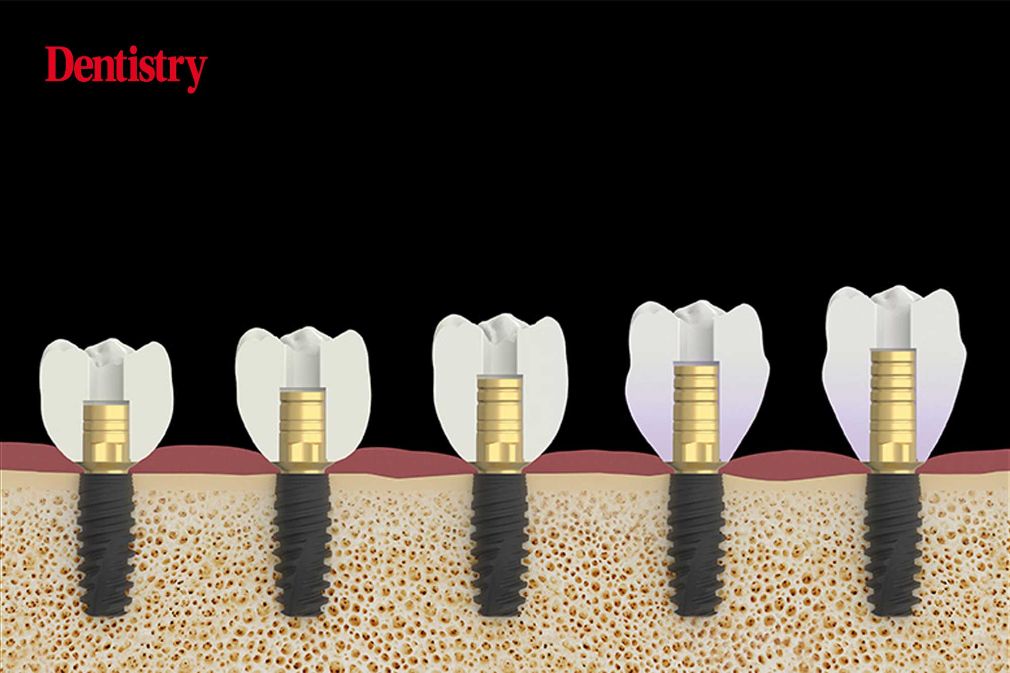 Zirkonzahn’s renewed range of implant prosthetic components