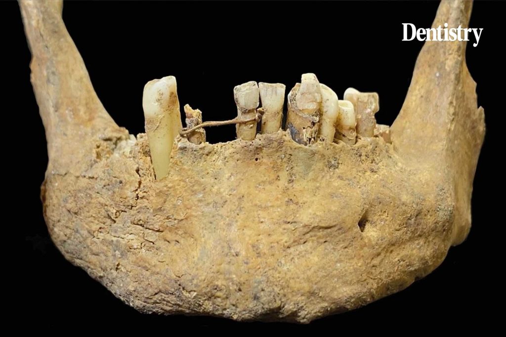 Is this medieval skeleton's golden bridge the first ever set of grillz?