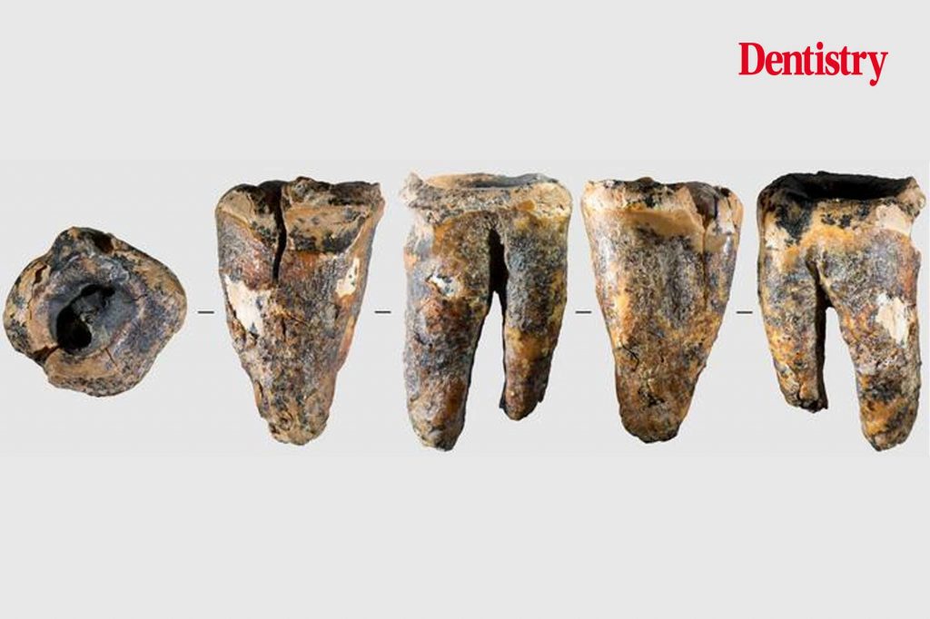 Neanderthal tooth shows signs of invasive dentistry 59,000 years ago