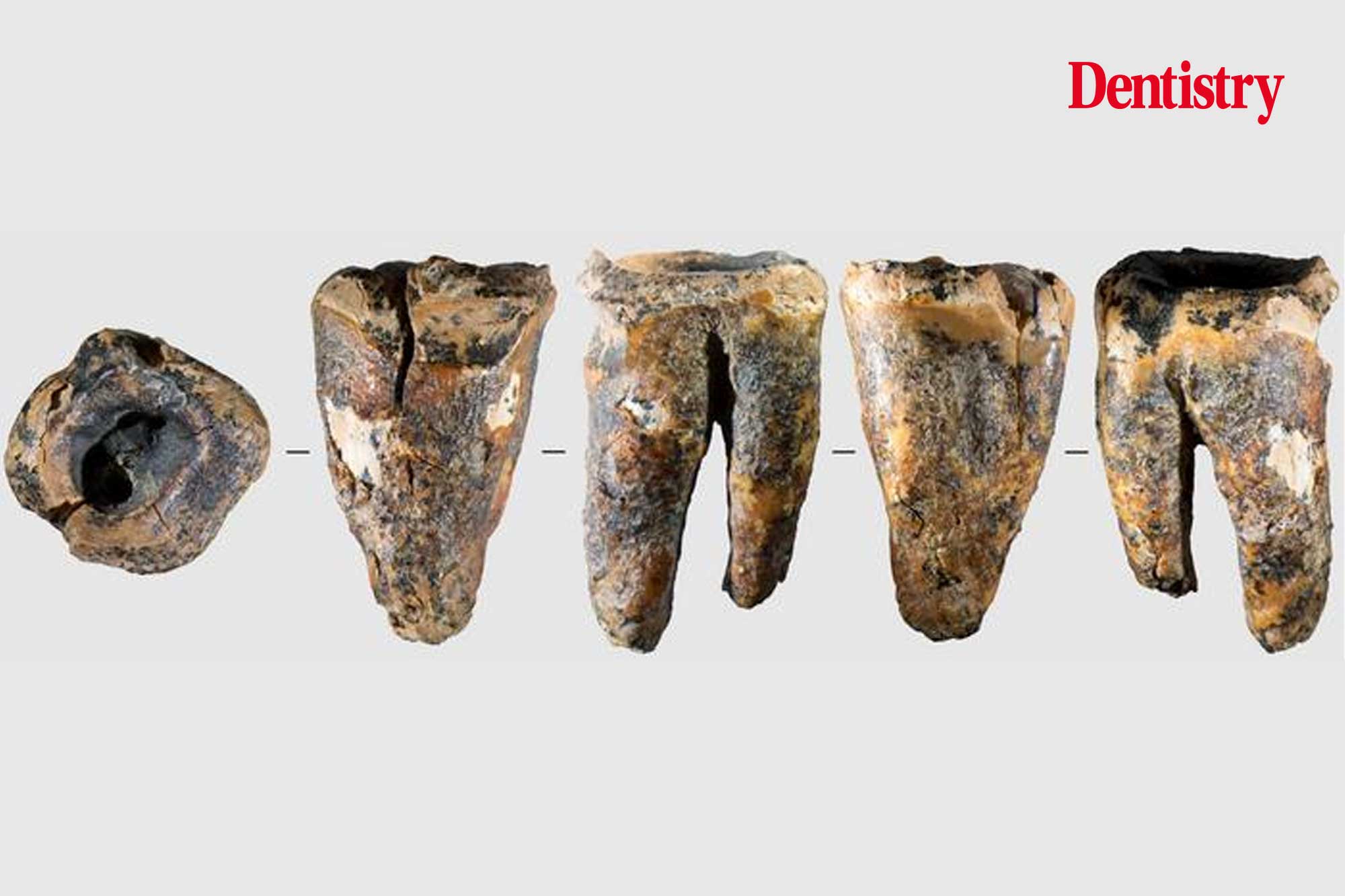 Neanderthal tooth shows signs of invasive dentistry 59,000 years ago
