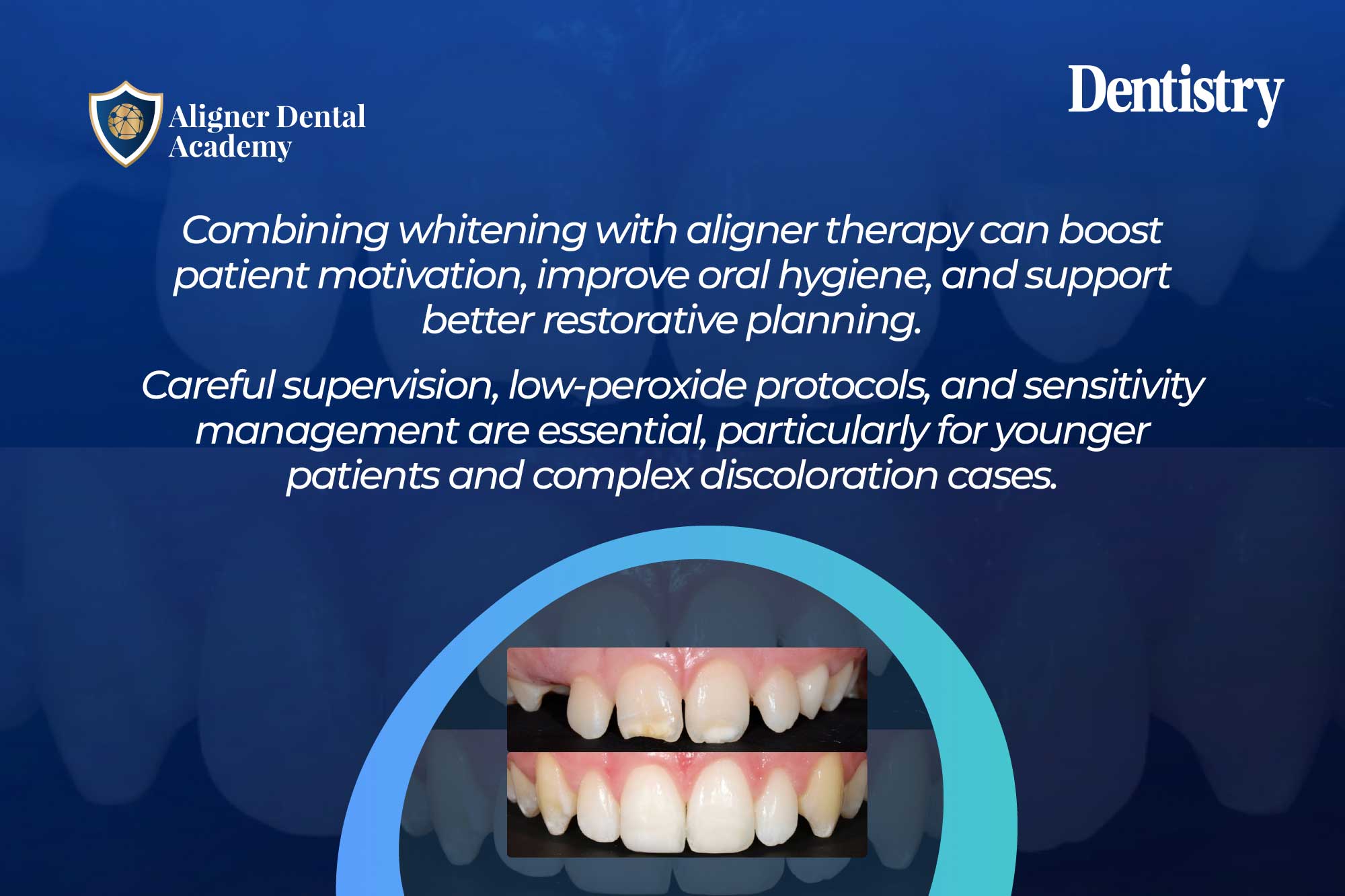 Whitening during Invisalign treatment: a modern approach to aesthetic dentistry