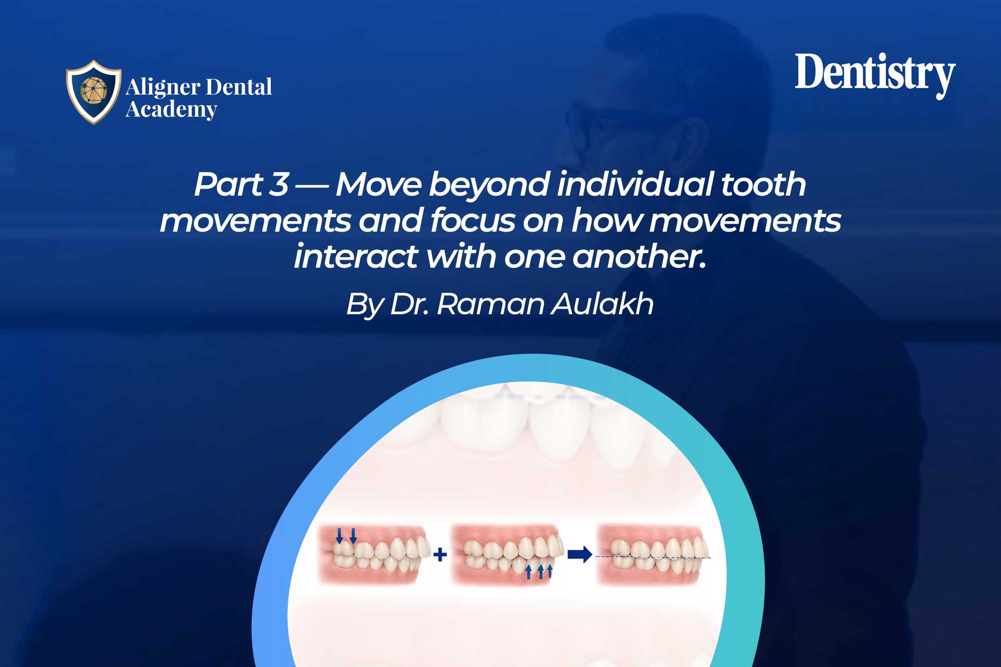 Movements that work together – and those that don’t – in clear aligner therapy