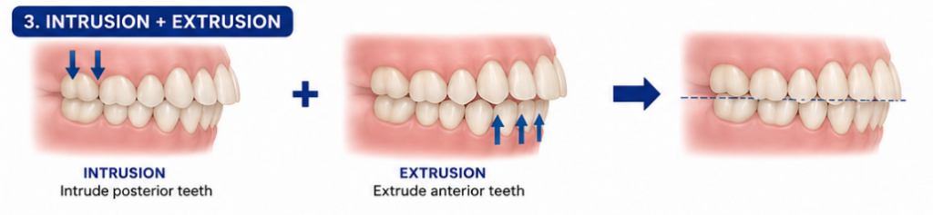 Movements that work together – and those that don’t – in clear aligner therapy