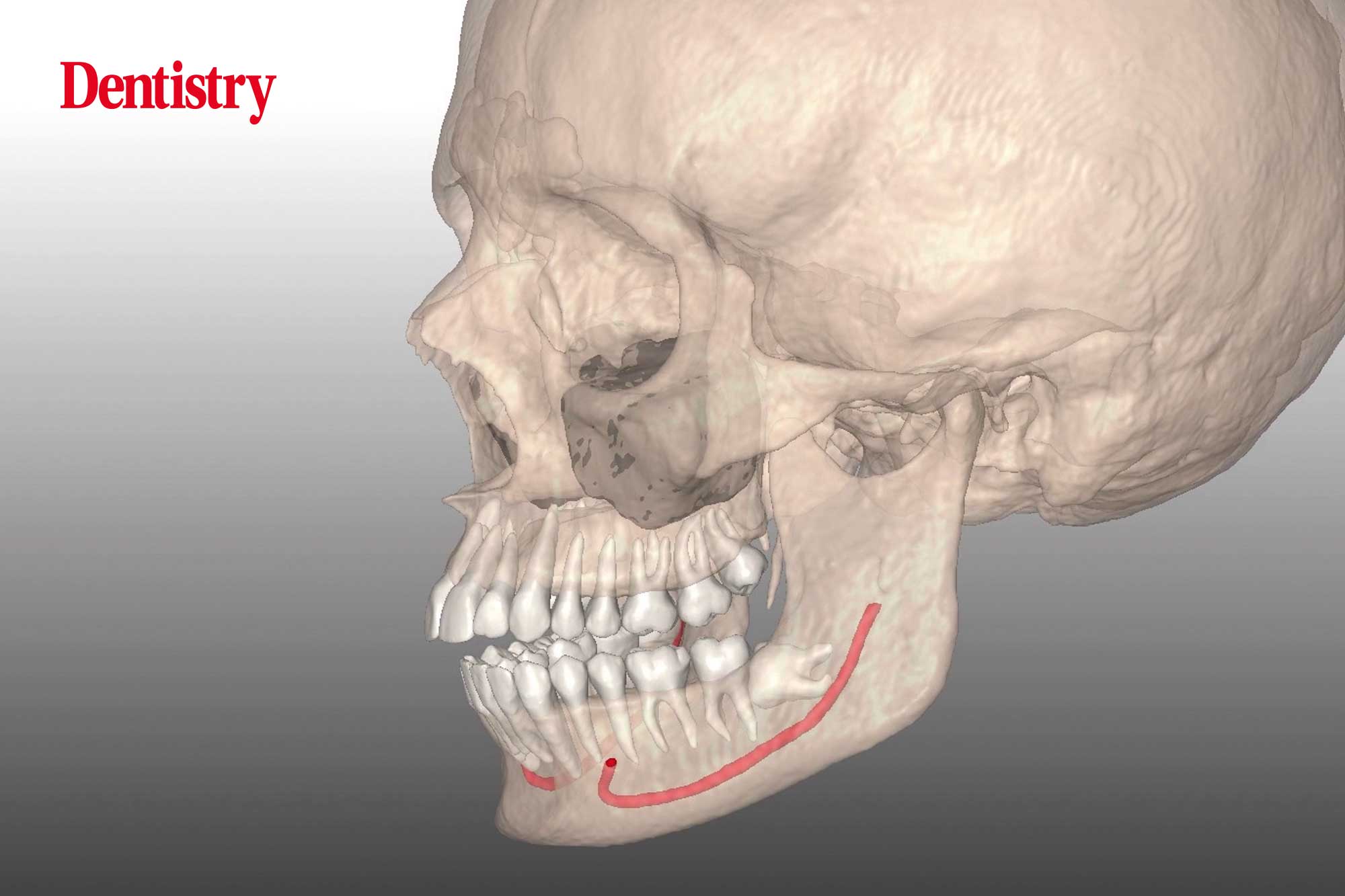 Zirkonzahn’s software offering: Zirkonzahn.Implant-Planner and Bone Doctor