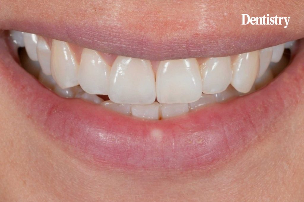 Case study: matching the single central crown