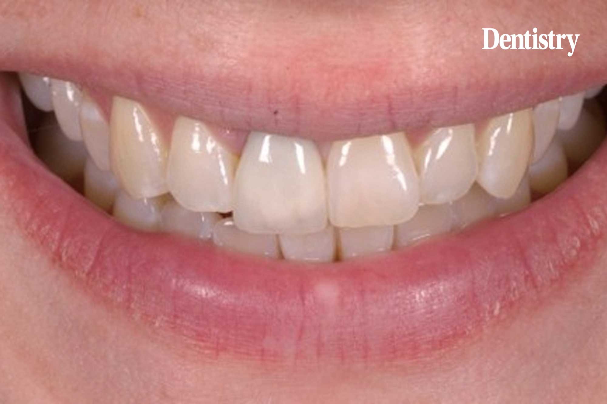 Case study: matching the single central crown