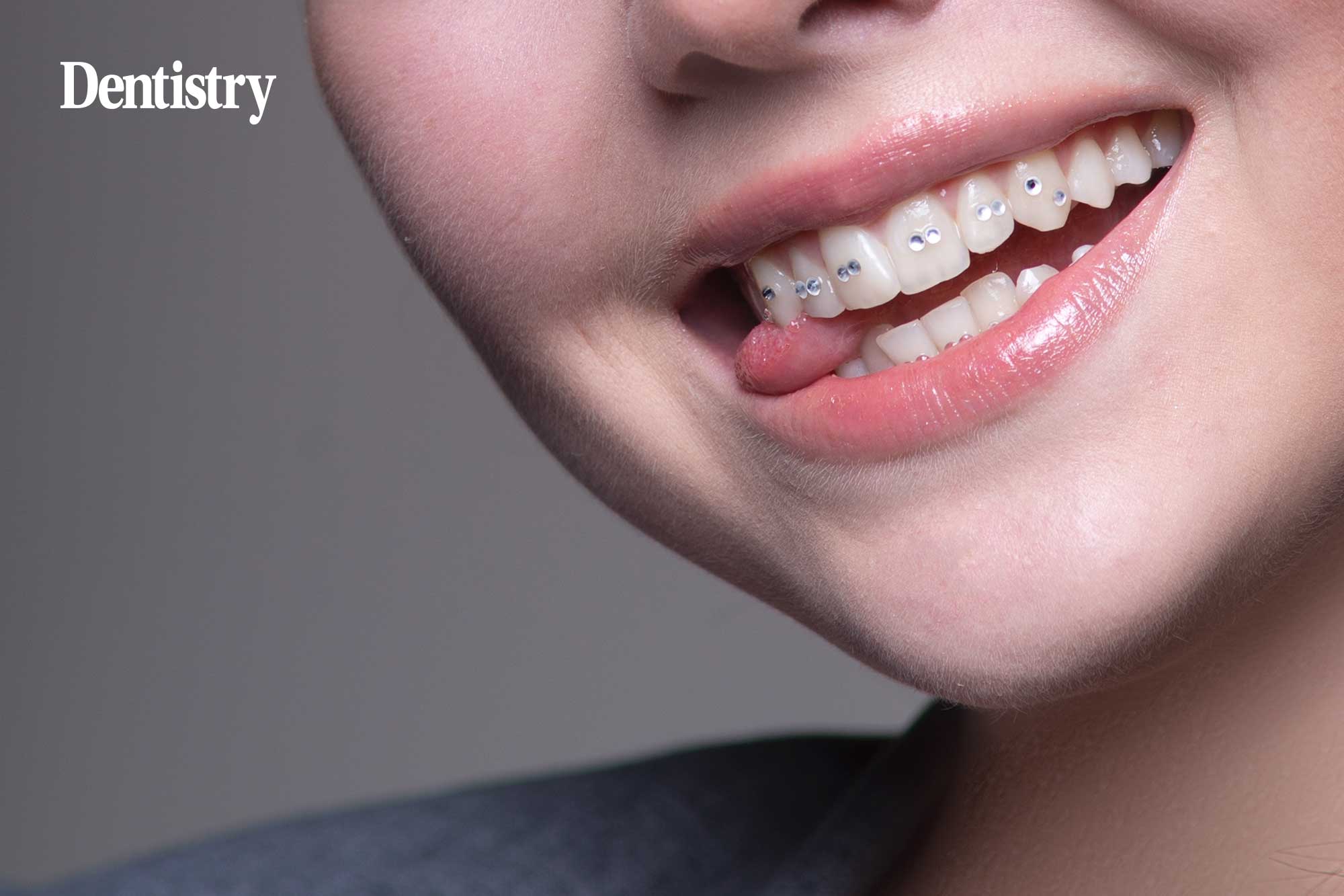 Tooth gems: the potential oral health risks dental professionals need to know